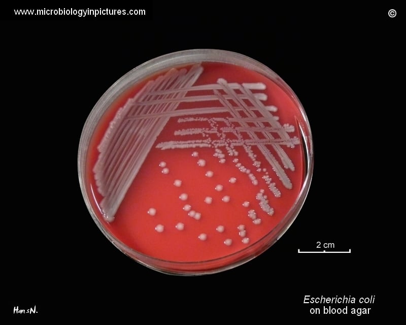 E. coli a provocat prostatita