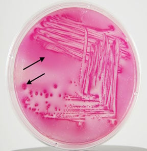 prostatita bacteriana e coli)