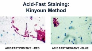 Acid Fast (Kinyoun-Cold Method)- Principle, Procedure and Result Interpretation