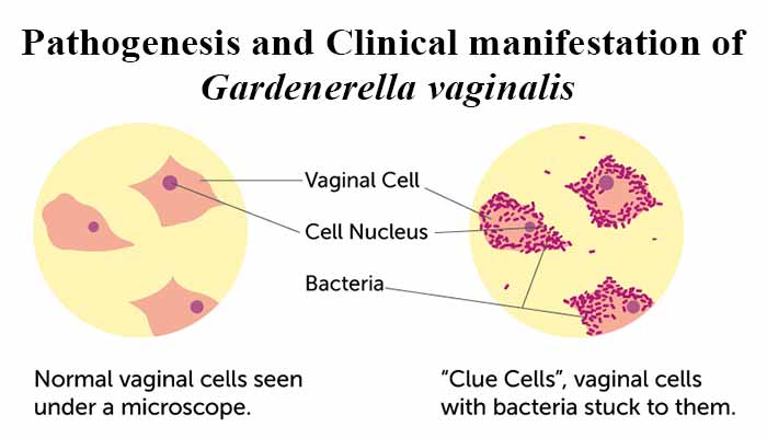 Pathogenesis and Clinical manifestation of Gardenerella vaginalis