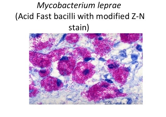 Laboratory diagnosis of Leprosy caused by Mycobacterium leprae