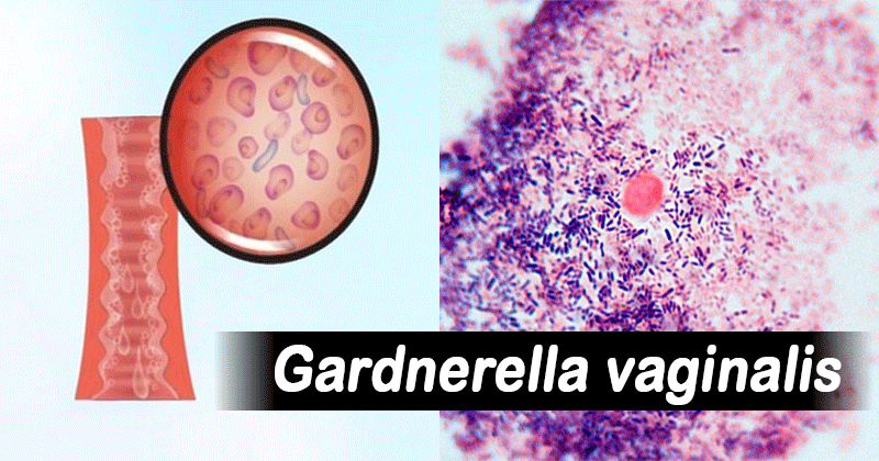 Habitat and Morphology of Gardnerella vaginalis