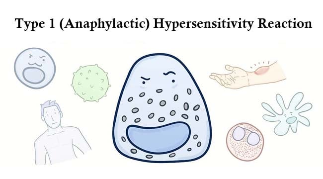 Type 1 (Anaphylactic) Hypersensitivity Reaction