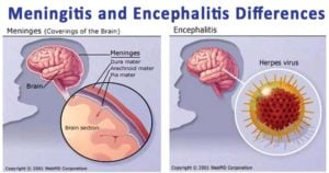 Differences between Meningitis and Encephalitis