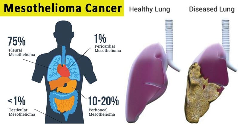 is mesothelioma diagnosed