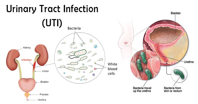 Urinary Tract Infection (UTI)- An Overview