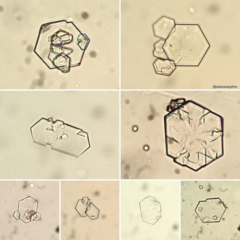 What Are The Types Of Crystals Found In Urine 6826