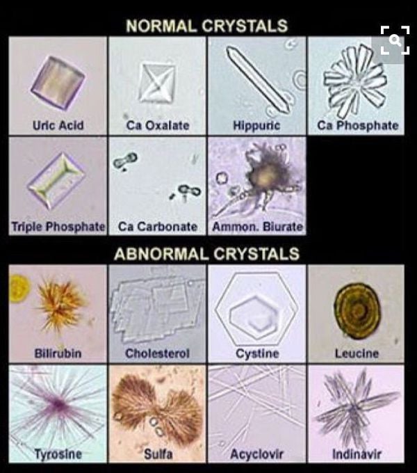 Normal and Abnormal urine crystals
