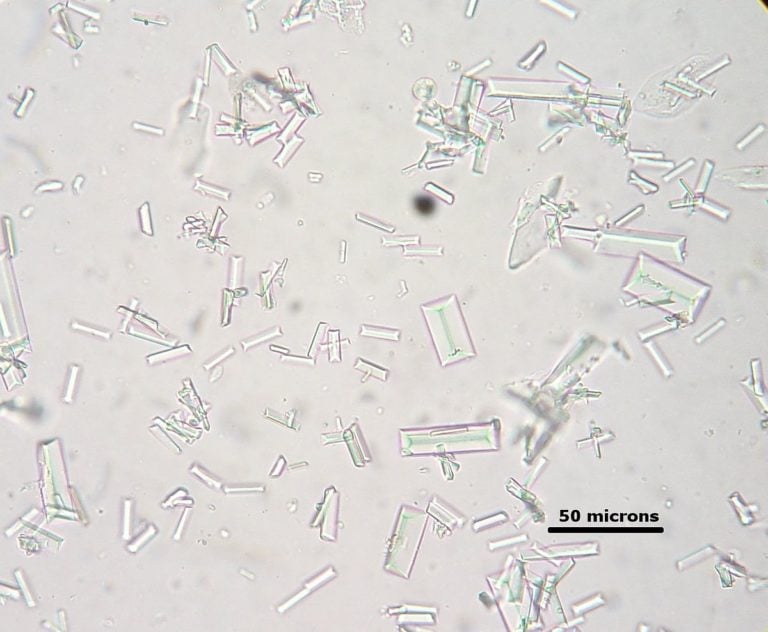 What Are The Types Of Crystals Found In Urine 6907