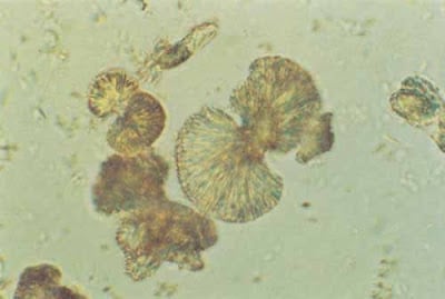 tyrosine crystals in urine