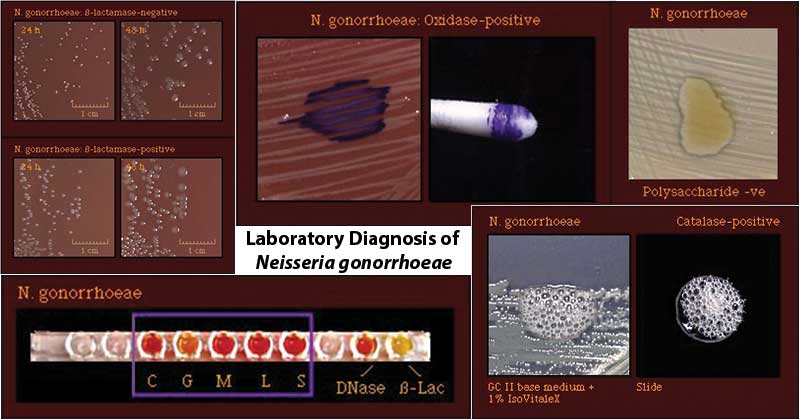Neisseria gonorrhoeae- Laboratory Diagnosis, Treatment, Prevention