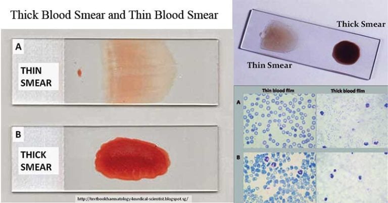 thick-blood-smear-and-thin-blood-smear