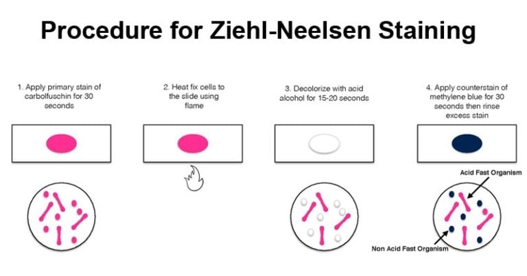 Ziehl Neelsen Staining Principle And Procedure With Results