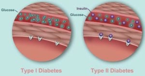 type 1 diabetes and type 2 diabetes