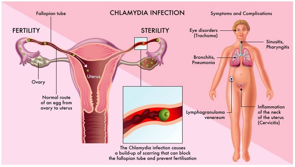 Clinical Manifestations of Chlamydia trachomatis