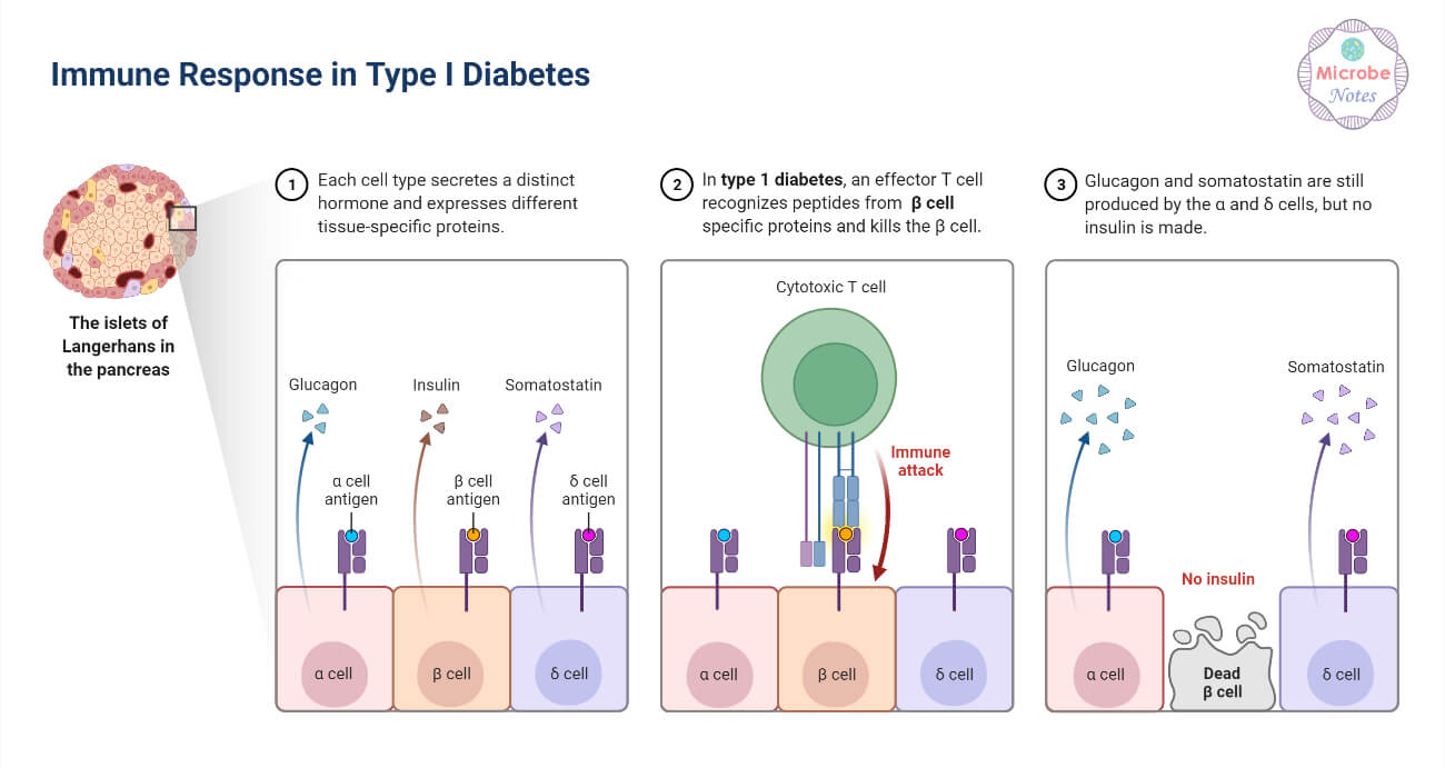 Immune Response in Type I Diabetes