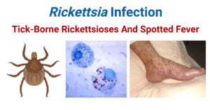 Rickettsia Infection- Tick-Borne Rickettsioses And Spotted Fever