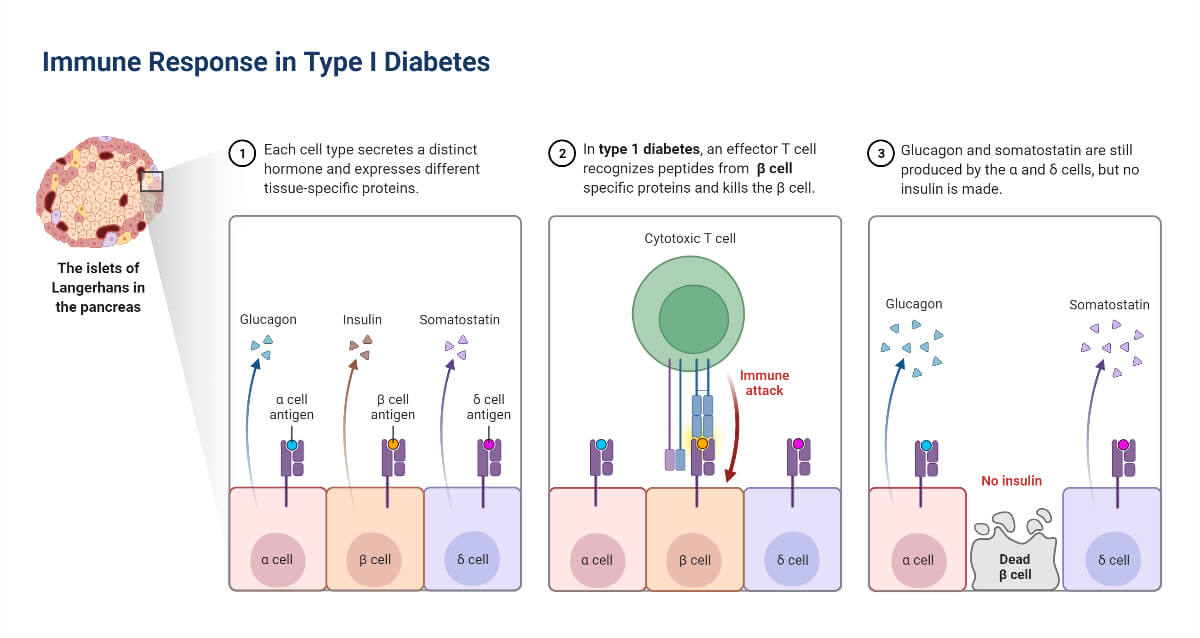 Immune Response in Type I Diabetes