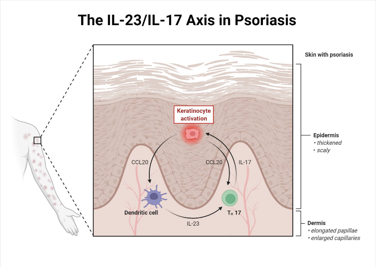 The IL-23_IL-17 Axis in Psoriasis