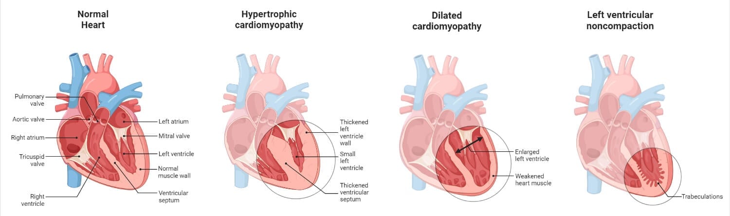 Cardiomyopathy (Heart Muscle Diseases)