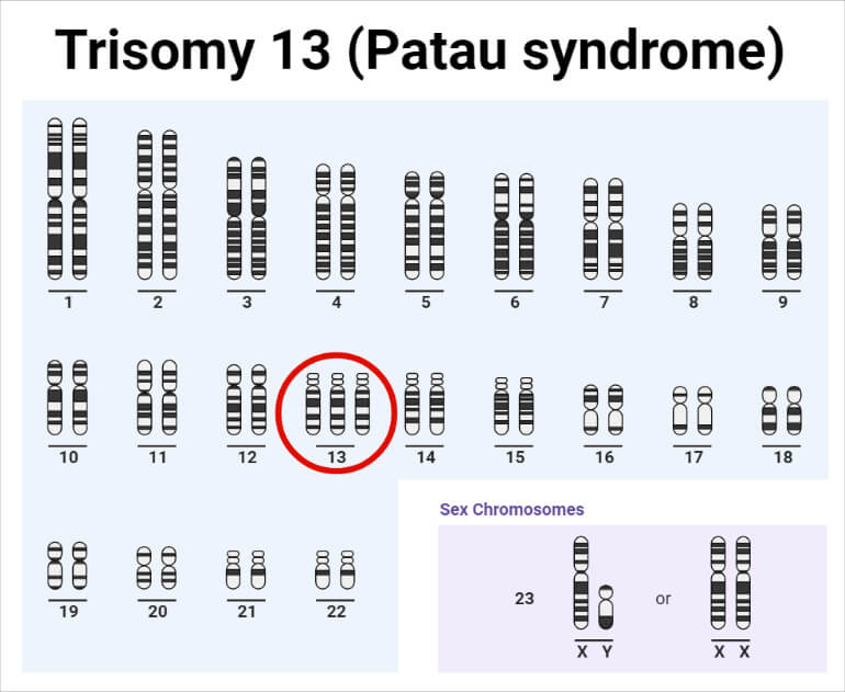 Trisomy 13 (Patau syndrome)