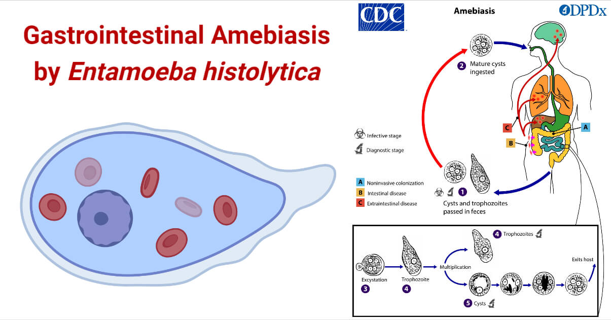 Gastrointestinal Amebiasis by Entamoeba histolytica