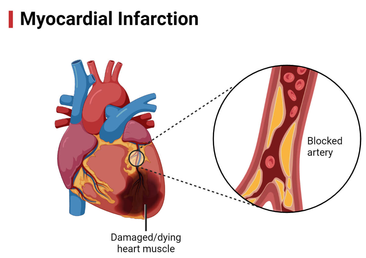 Myocardial Infarction- (Heart Attack)