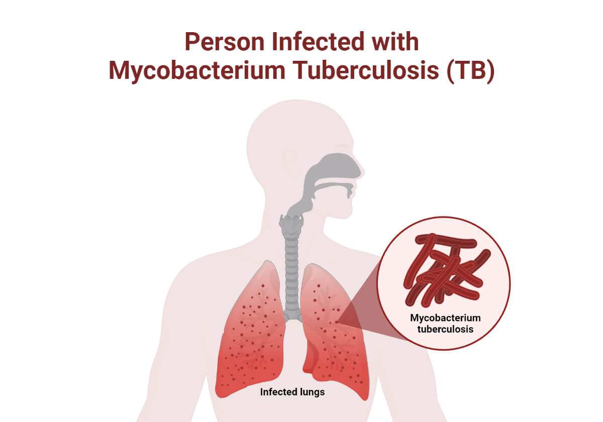 Person Infected with Mycobacterium Tuberculosis (TB)