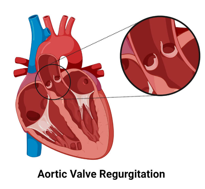 Aortic Valve Regurgitation 