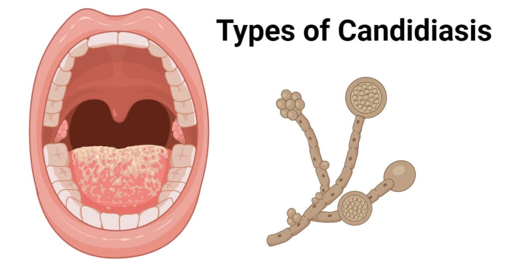 Types Of Candidiasis With Transmission And Pathogenesis Microbe Notes 