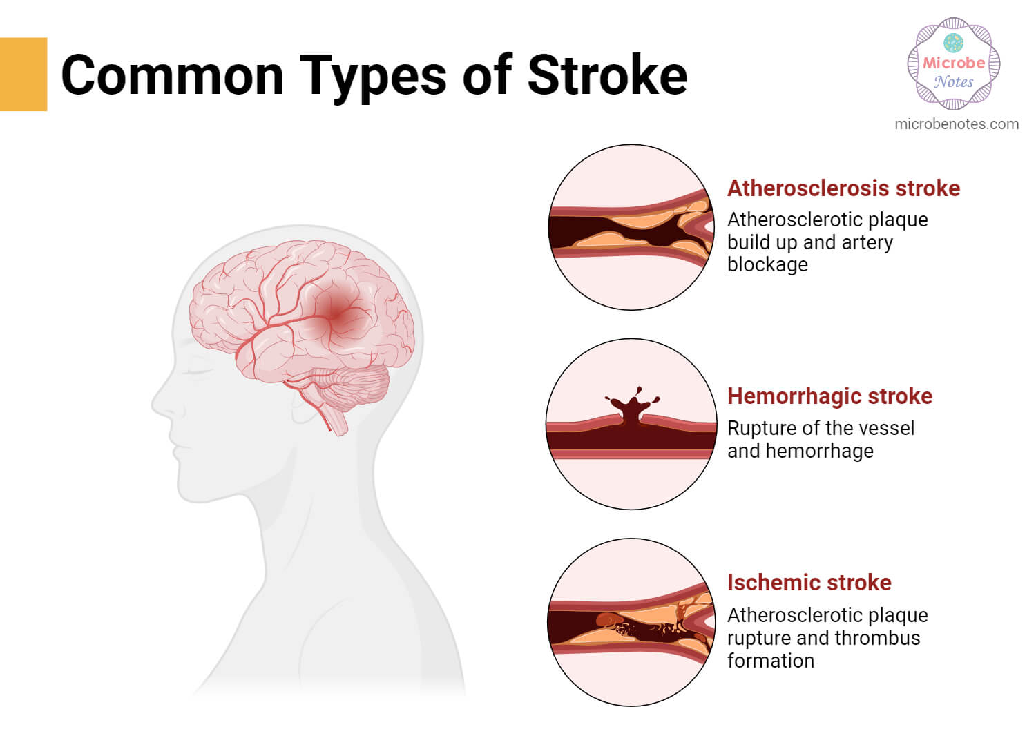 Common Types of Stroke