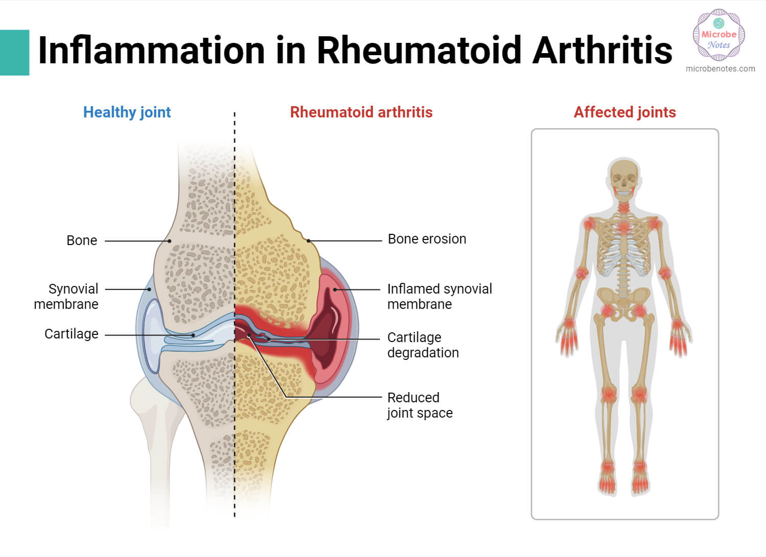 Inflammation in Rheumatoid Arthritis