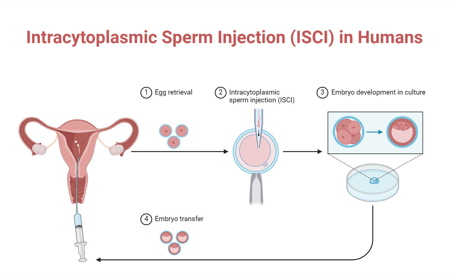 Intracytoplasmic Sperm Injection (ISCI) in Humans