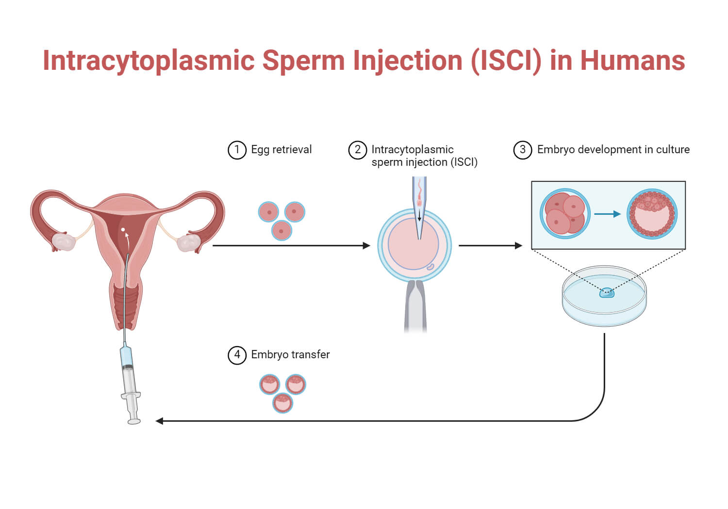 Intracytoplasmic Sperm Injection (ISCI) in Humans