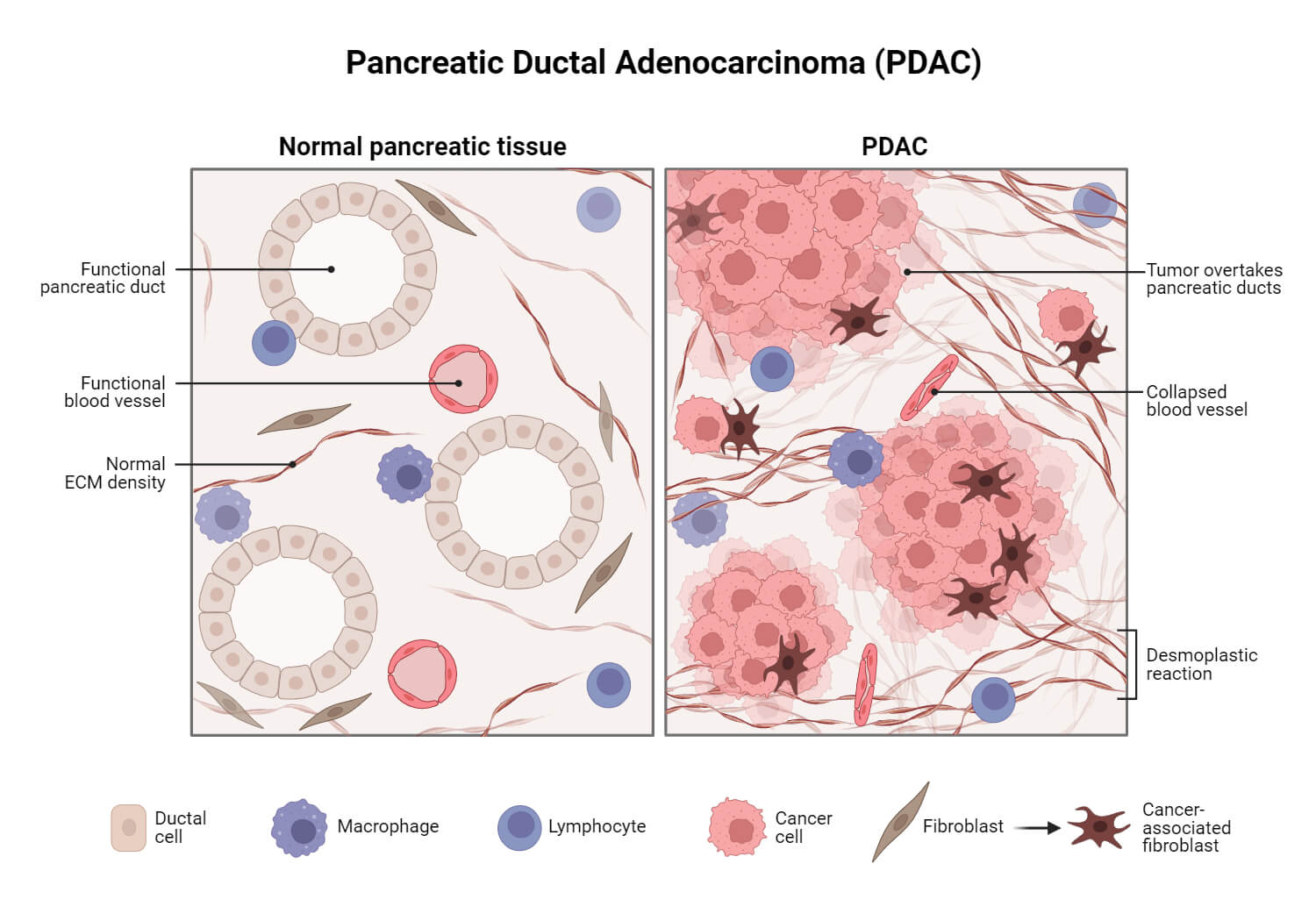 Pancreatic Ductal Adenocarcinoma (PDAC)