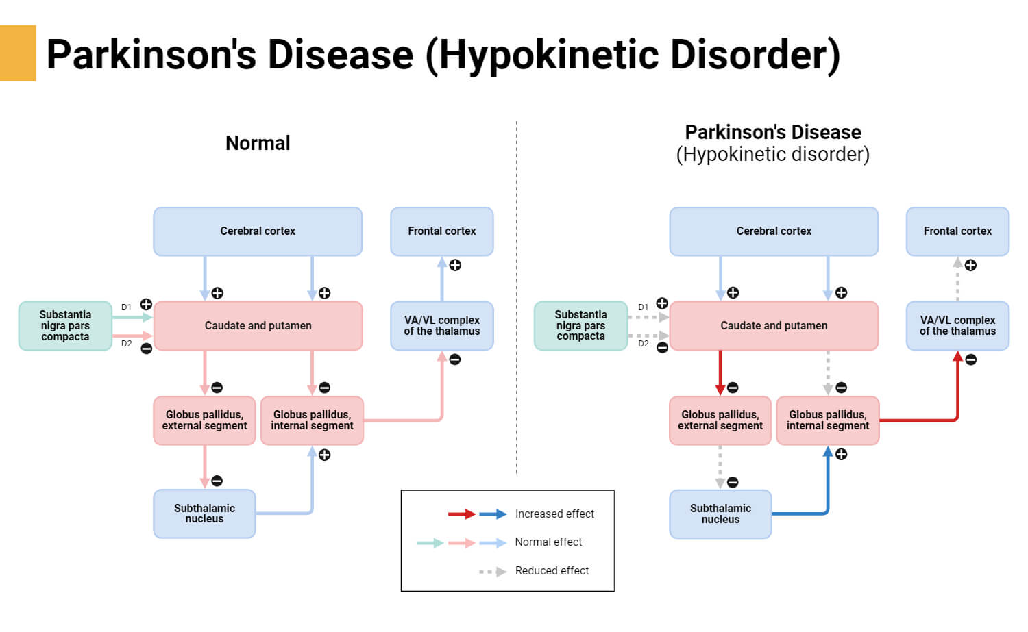 Parkinson's Disease (Hypokinetic Disorder)