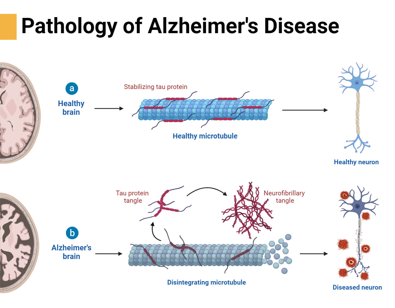 Pathology of Alzheimer's Disease