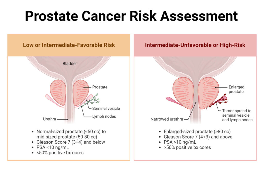 Prostate Cancer Risk Microbiological Risk Assessment: Types and Applications