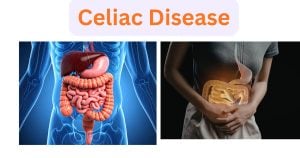Celiac Disease