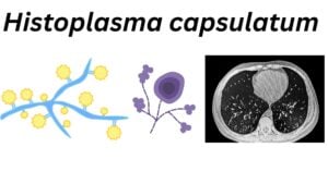 Histoplasma capsulatum H. capsulatum