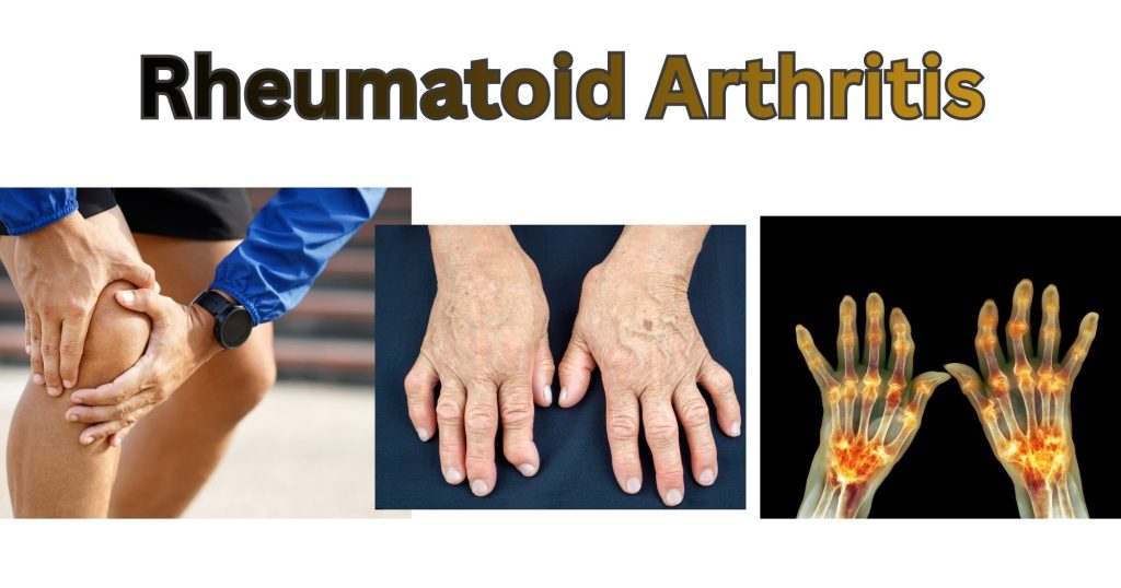 Rheumatoid Arthritis