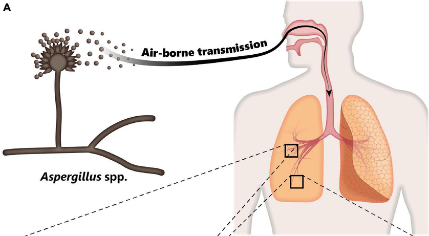 image 112 Inhalation of Aspergillus spores