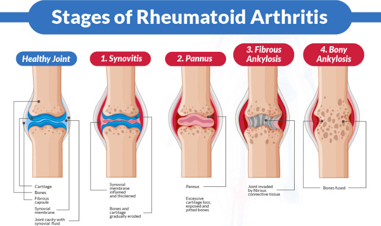 image 36 Stages of RA