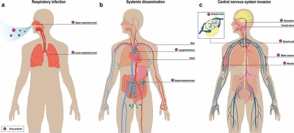image 64 Hypothetical model of pathogenesis of EV-D68