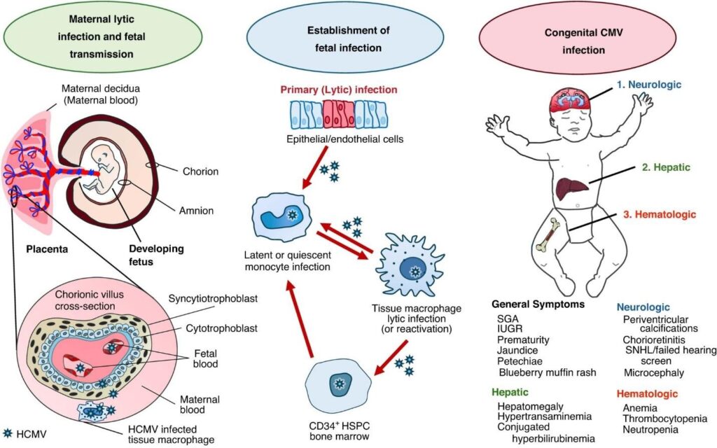 image 69 Pathophysiology of congenital cytomegalovirus infection