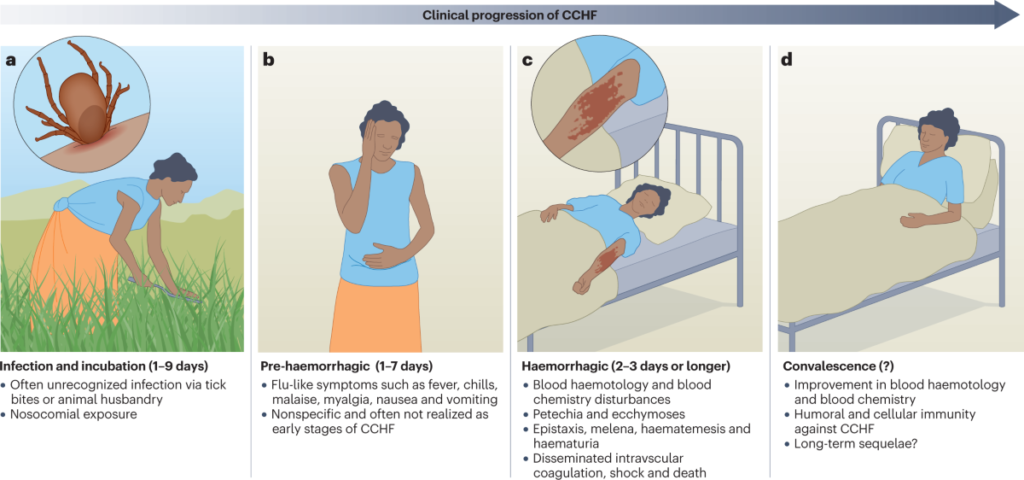 image 86 Clinical progression of Crimean–Congo hemorrhagic fever