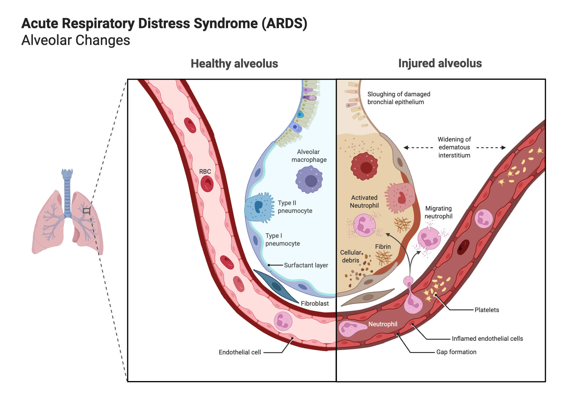 Acute Respiratory Distress Syndrome ARDS Acute Respiratory Distress Syndrome (ARDS)
