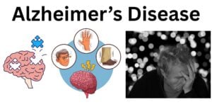 Alzheimers Disease Alzheimer’s Disease