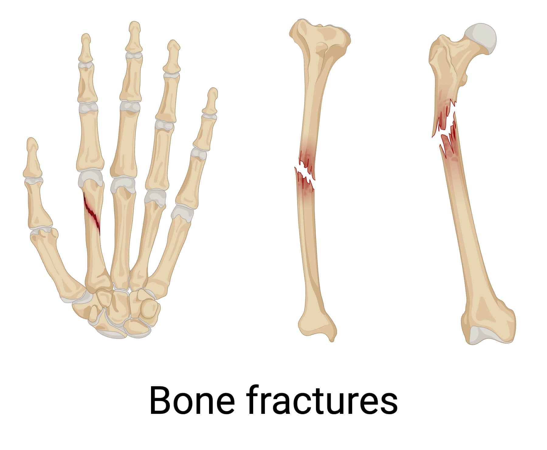 Bone fractures Bone fractures