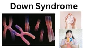 Down Syndrome Down SyndromeÂ